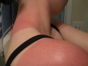 avoiding sunburn